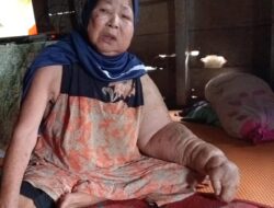 Erma Penderita Tangan Membengkak di Madina Butuh Bantuan Perobatan